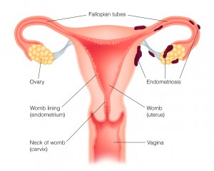 What is Endometriosis? Let’s know about it